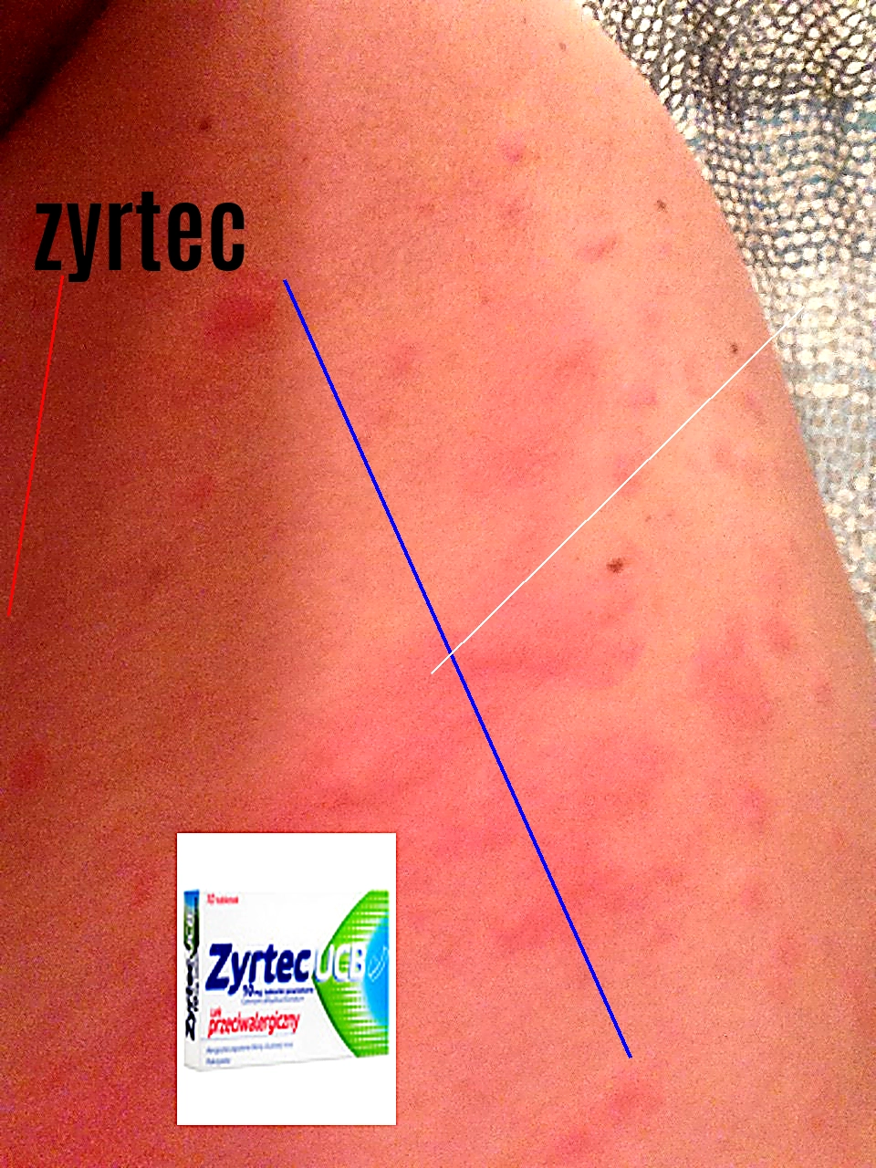 Prix du zyrtec en france